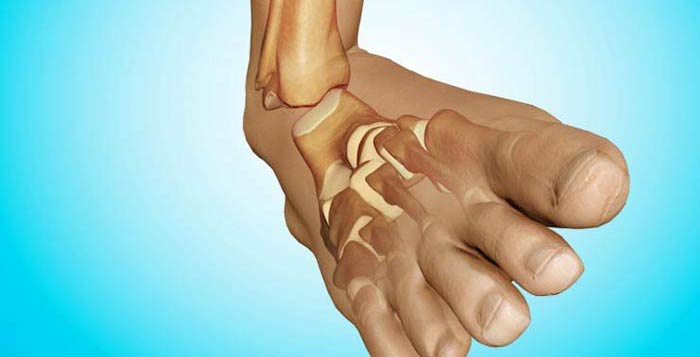 مراقبت های بعد از شکستگی استخوان کف پا