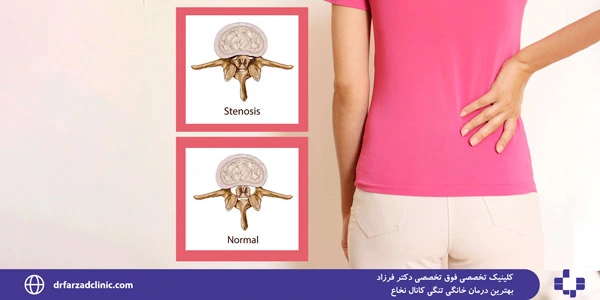 The-best-home-treatment-for-spinal-stenosis