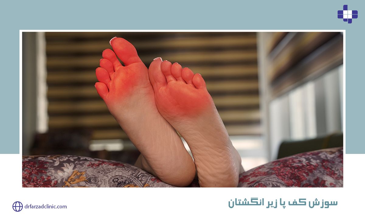 سوزش کف پا زیر انگشتان