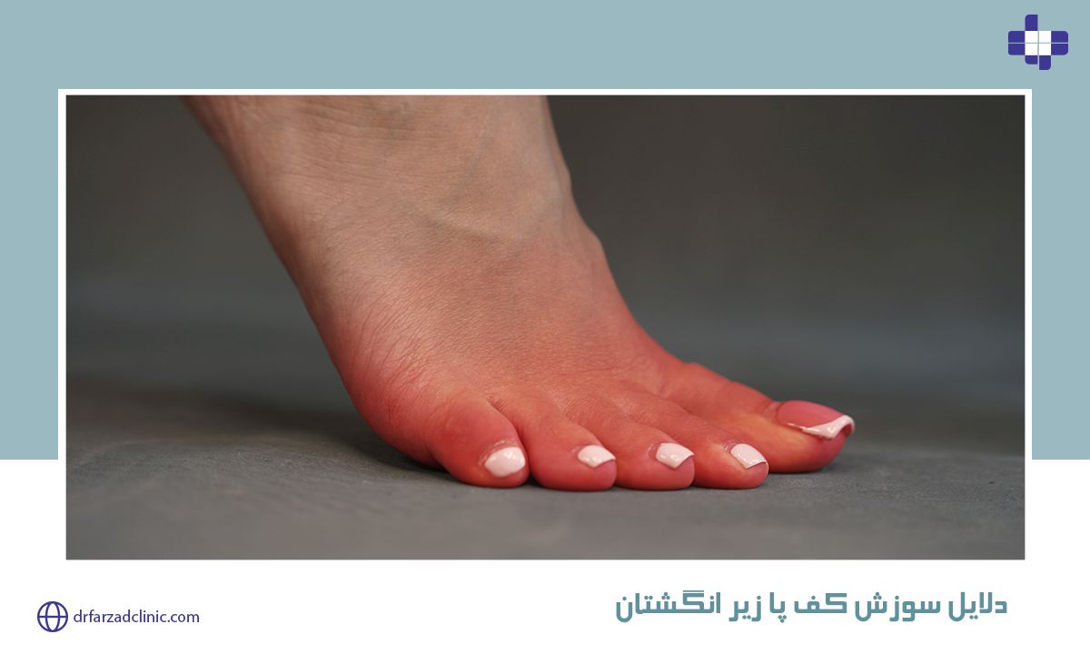 دلایل سوزش کف پا زیر انگشتان
