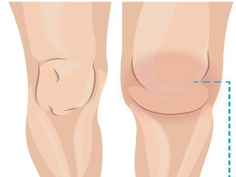 Home-treatment-swollen-knees