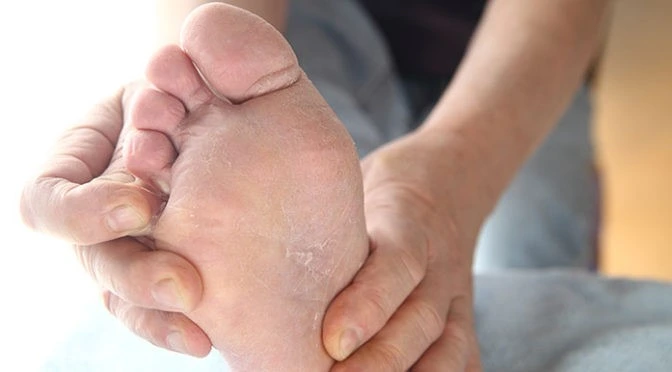 Treatment-burning-itching-soles-feet