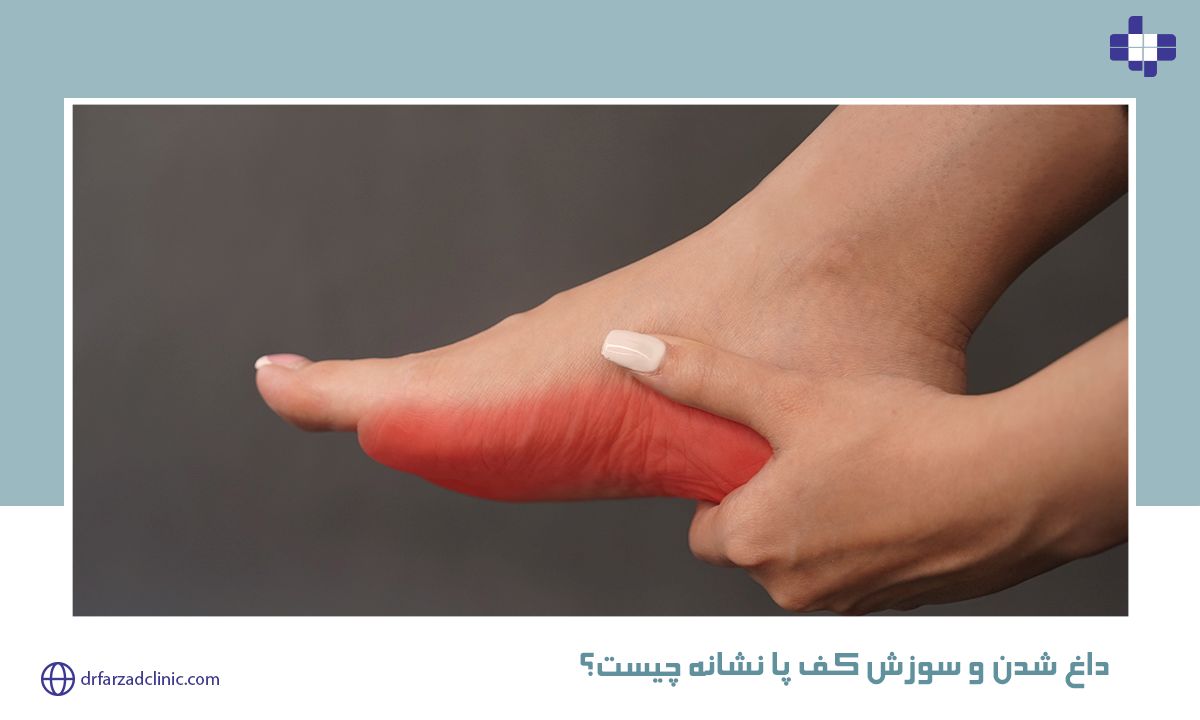 داغ شدن و سوزش کف پا نشانه چیست؟